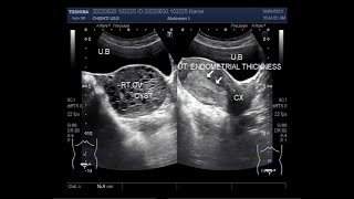 Endometrial Hyperplasia and Hemorrhagic Ovarian Cyst [upl. by Asilrahc295]