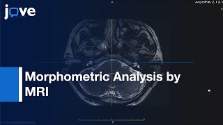 Morphometric Analysis Human Cranial Nerves Menières Disease amp Normal Ears by MRI [upl. by Esiuole345]