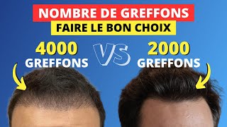 Combien faut il dimplants pour une greffe de cheveux réussie [upl. by Eedya]