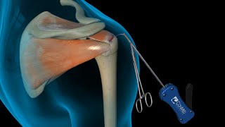 ConMed Linvatec Rotator Cuff Shoulder Surgery [upl. by Aleil]