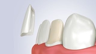 Cementazione faccetta dentale in disilicato di litio step by step [upl. by Pessa]