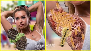 ASMR Dog Ticks Worm amp Trypophobia Removal Treatment Infected Armpit  ASMR Treatment Animation [upl. by Mongeau]