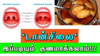 டான்சில்க்கு எளிய வீட்டு வைத்தியம் Tonsils and Adenoids treatment [upl. by Leahey754]