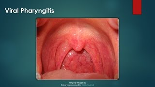 Viral Pharyngitis [upl. by Macpherson]