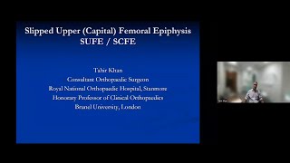 Slipped upper capital femoral epiphysis SUFE by Mr Tahir Khan [upl. by Fidele]