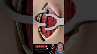 3D animation intubation procedure shorts youtubeshorts hospital viralvideo [upl. by Flosser]