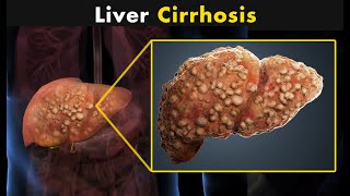 What Happens In Liver Cirrhosis  Symptoms Causes And Treatment [upl. by Yelrah]