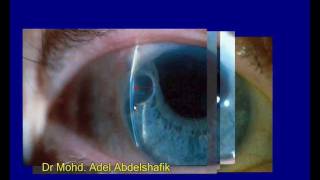 Slit lamp examination  whole presentation [upl. by Holle]