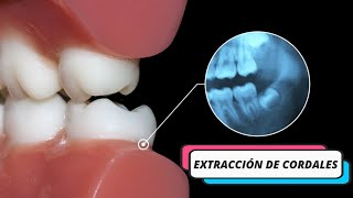 Cirujana especialista Extracción Cordales  Maxilofacial ¿En qué casos se requiere esta cirugía [upl. by Acinehs]