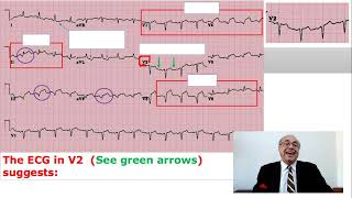 EKG Trainer Case 4 Questions [upl. by Antonia]