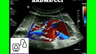 Vascular Sonography [upl. by Airdnahc80]