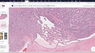 Retiform Sertoli Leydig Cell Tumor of Ovary [upl. by Falito507]