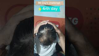 4rth day used minoxidil morr f5 results  adivasi hair oil results minoxidil adivasihairoilreview [upl. by Wolfson]