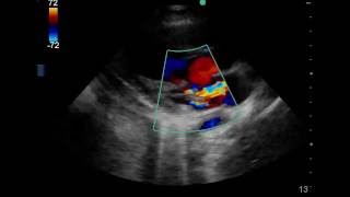 11 yo Girl with Fever Of Unknown Origin x 2 weeks with 1 day of Confusion [upl. by Anivla]