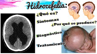 HIDROCEFALIA  CASO CLÍNICO  Fisiopatología  Síntomas  Diagnóstico  Tratamiento en 6 MINS [upl. by Kerr]