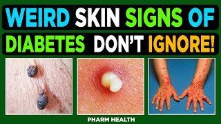 8 Diabetic Skin Problems amp Top Signs of Diabetes on the Skin  Dont Ignore [upl. by Clarie]