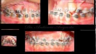 Orthodontic Treatment  Class III  Time Lapse [upl. by Berthoud]