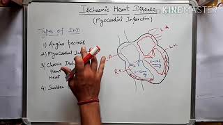 Ischaemic heart disease  Myocardial infarction in hindi Part1 [upl. by Sayre725]