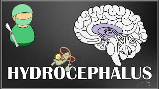 Hydrocephalus  Causes Types Signs and Symptoms Pathophysiology Diagnosis and Treatment [upl. by Etteuqram56]