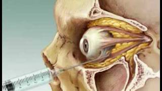 Eye Anesthesia Retrobulbar block [upl. by Nomi]