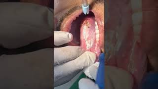 LEUKOPLAKIA REMOVAL [upl. by Ecnerrot788]