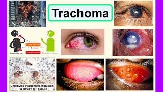 trachoma [upl. by Otsirave]