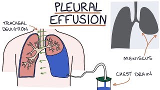 Understanding Pleural Effusions [upl. by Barhos]