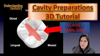 EASY Dental Cavity Preparation 3D TUTORIAL and Step by Step Guide Class I Amalgam Class 1 [upl. by Irolam]