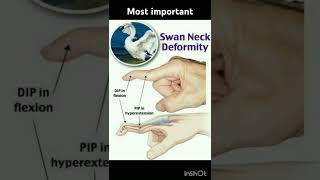 Swan neck deformaity viralshort norcetstudytips biology medicaleducation anatomy allaboutno [upl. by Xyno170]