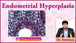 48 Endometrial Hyperplasia [upl. by Trixie268]