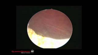 Thulium laser bladder neck incision [upl. by Sharla]