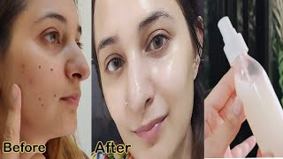 I Used Rice Water For 3 Months and the result is Amazing All Acne Dark Spots Dull Skin Gone [upl. by Biamonte171]