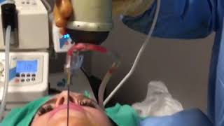 Chin Liposuction [upl. by Meli340]