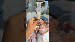 Tube Feeding medical newbornbaby viralvideo [upl. by Elburr]