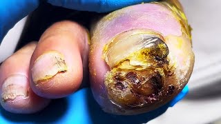 Extremely severe onychomycosis the fungus has infected the entire toe【Mr Lin Toenail】pedicure [upl. by Adnwahsor]