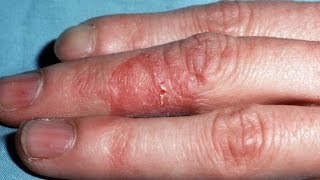 Hand dermatitis  Home remedies for dermatitis  Dermatitis remedies [upl. by Kettie]