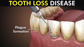 Periodontitis or Gum disease 3d animation included [upl. by Neiv]