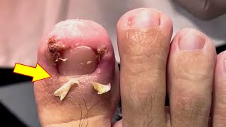 Ingrown toenail removal treatment [upl. by Chandless737]