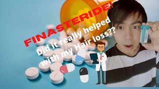 8th month review with FINASTERIDE for HAIR LOSS Filipino [upl. by Nhguavoj]