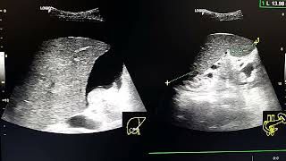 buddchiari syndrome ultrasound [upl. by Neliac951]