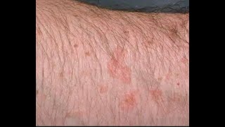 How to Removed Flat warts thru portable electric cautery underarm viral skincare warts trending [upl. by Aynwad]