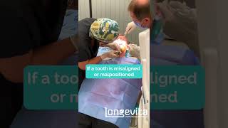 When is Extraction Needed Before dentalimplants   Longevita [upl. by Lalo]