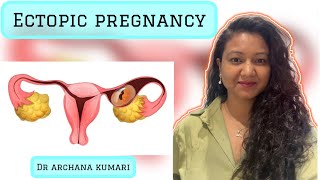 Ectopic pregnancy and its management ectopicpregnancy ectopic [upl. by Timotheus]