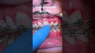 FLOSSING BRACES with Interproximal Brush oralhealth oralhygiene viral youtubeshorts shorts fy [upl. by Blythe888]