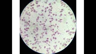 microcytic hypochromic anaemia [upl. by Andersen]