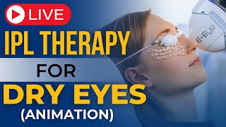 IPL Therapy For Dry Eyes I Live IPL Therapy for Dry Eyes Animation [upl. by Jewel]