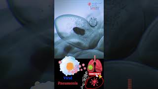 Pneumonia  Respiratory infection  Viral pneumonia  Medical Arts shorts [upl. by Evonne]