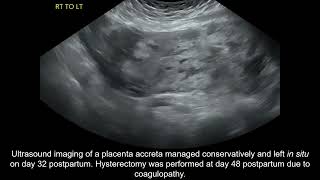 Placenta accreta spectrum conservative management and coagulopathy [upl. by Rai]