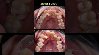 Cost  2500 for this case Braces crooked teeth braces orthodontist dentist [upl. by Anikehs]