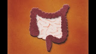 Patología Isquémica Intestinal Definición Evaluación Tratamiento [upl. by Patman]